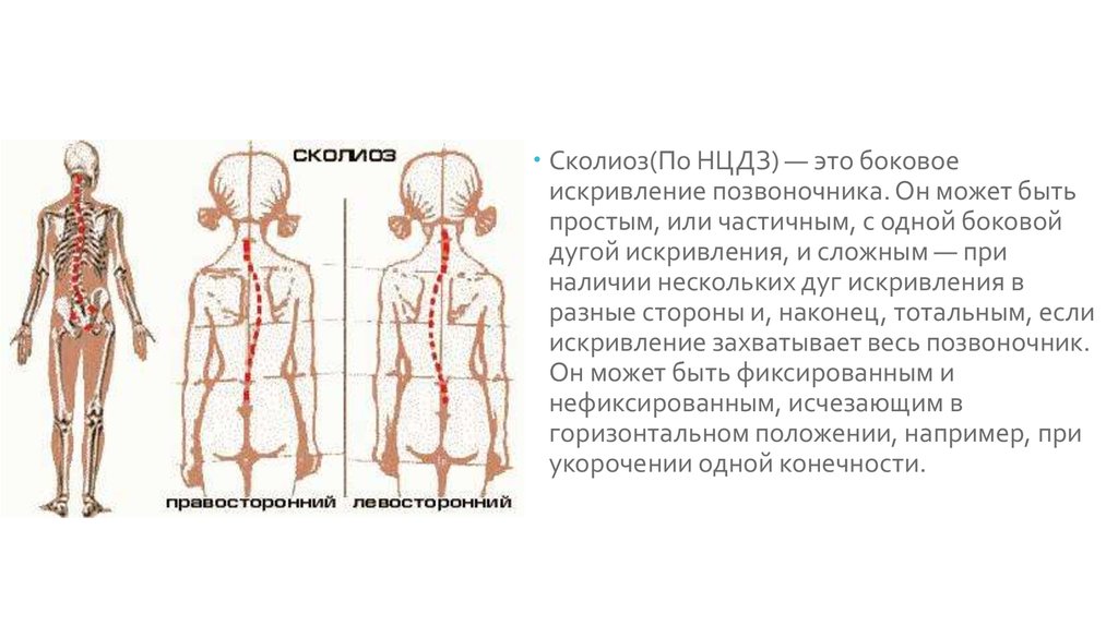 Сколиоз в 16