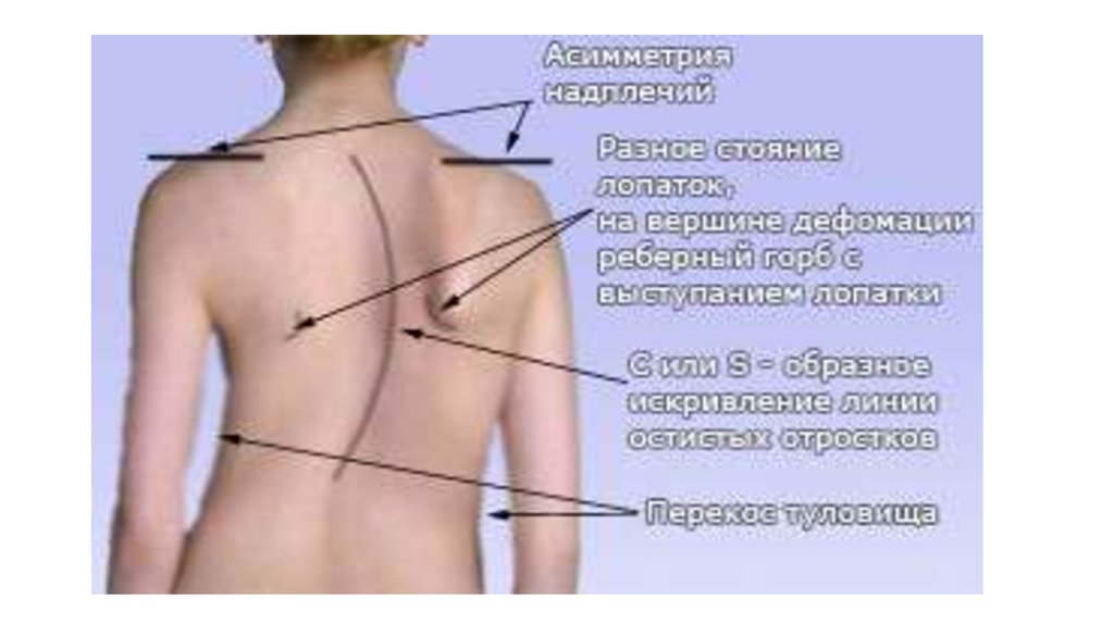 Находимся на разных. Асимметрия лопаток при сколиозе. Лопатка человека.