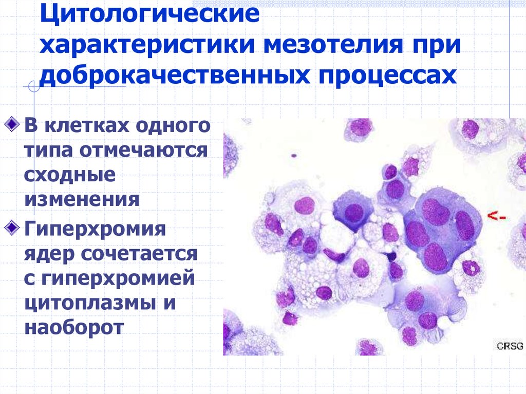 Реактивные изменения лейкоцитов. Цитология выпотных жидкостей атлас. Клетки мезотелия цитология. Пролиферация мезотелия. Исследование плевральной жидкости клетки мезотелия.