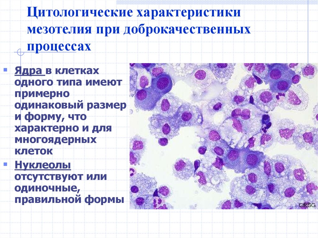 Атипичные клетки в цитологии что это. Цитология выпотных жидкостей атлас. Клетки мезотелия цитология. Биопсия желудка на цитологию. Пролиферация мезотелия.