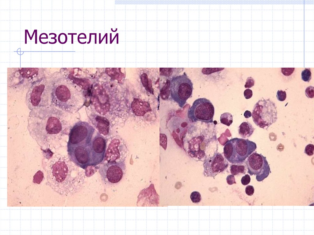 Цитологическая картина мезотелиомы