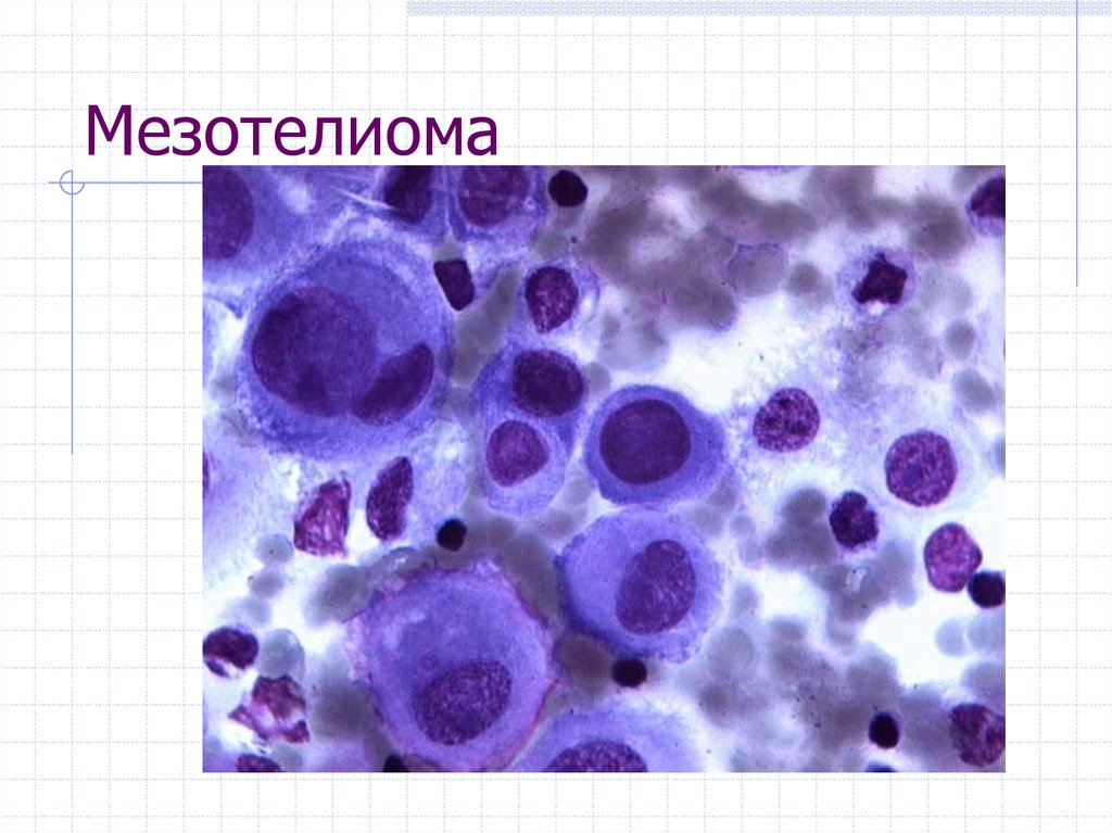 Цитологическая картина мезотелиомы