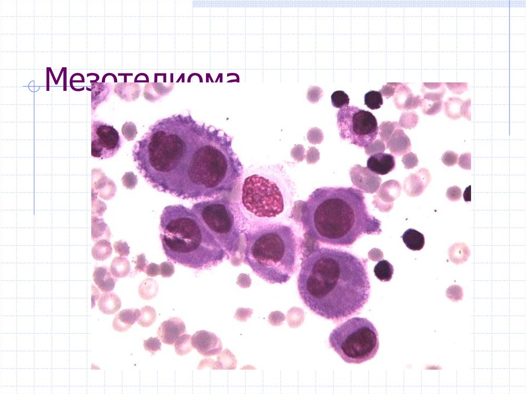 Цитологическая картина мезотелиомы