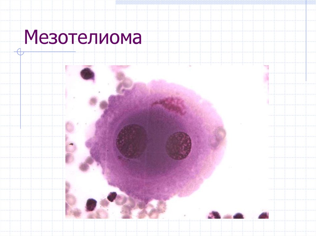 Цитологическая картина мезотелиомы