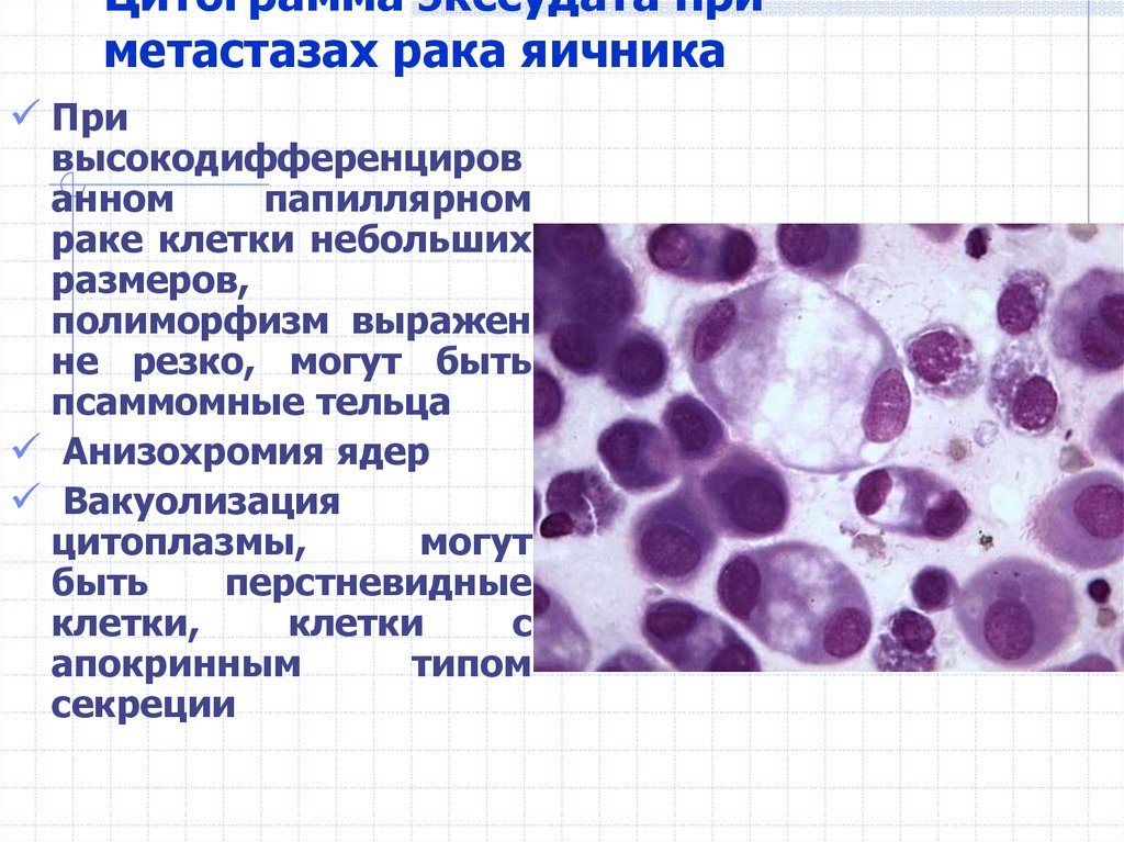 Метастазы при раке яичников фото