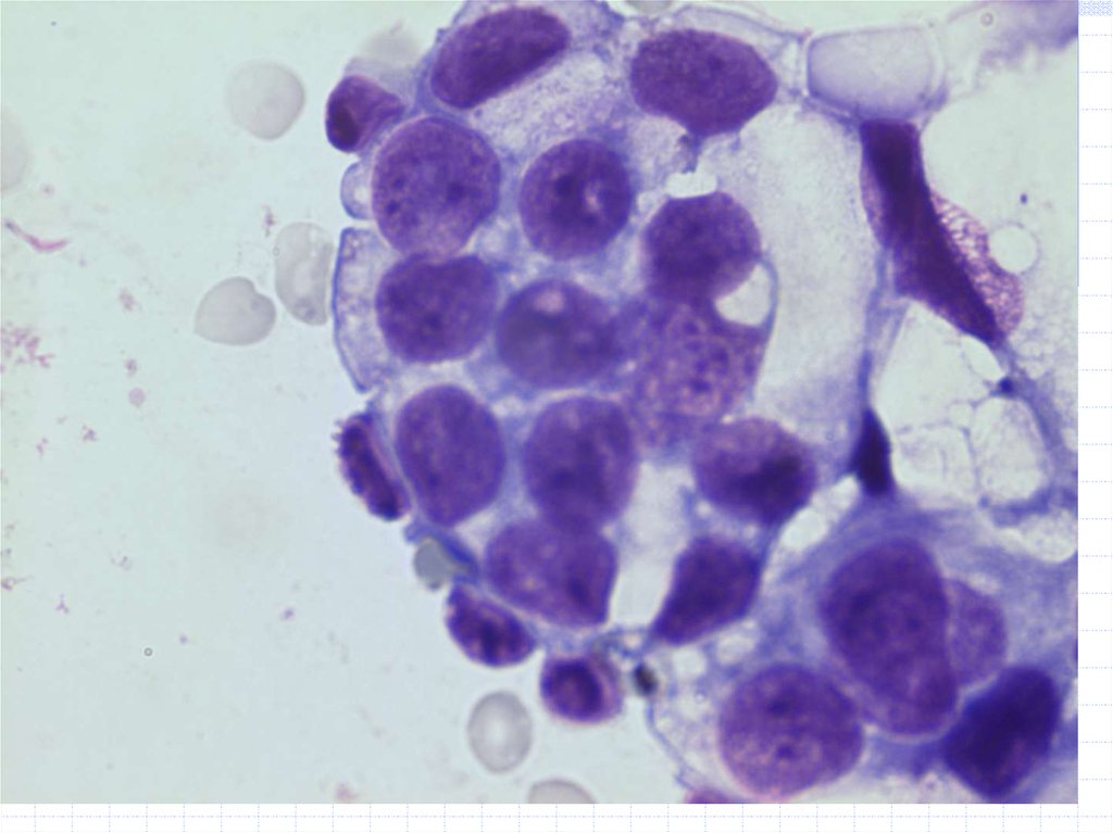 Выпотные жидкости. Цитология выпотных жидкостей атлас. Кератома цитологическая картина. Базалиома кожи цитологическая картина. Микроскопия выпотных жидкостей.