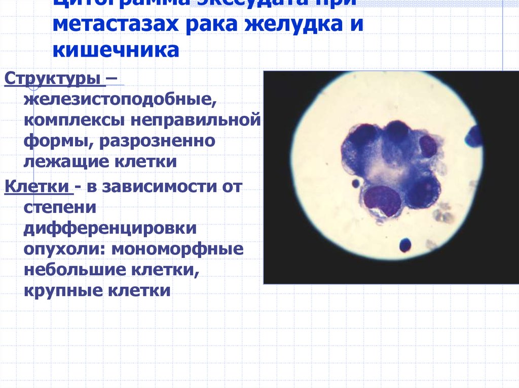 Цитограмма. Цитологическая диагностика выпотных жидкостей. Плазматические клетки в выпотной жидкости. Эритроциты в выпотных жидкостях.