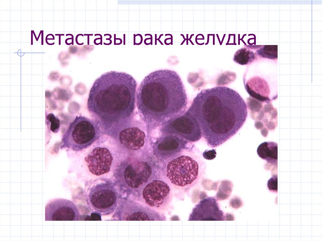 Рак желудка метастазы. Цитологическое исследование желудка. Интраоперационная цитология. Метастазы в печень цитологическая картина.