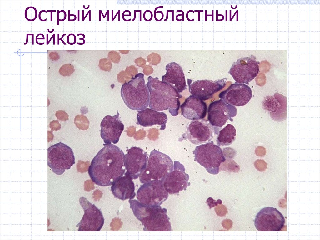 Миелоидный лейкоз. ОМЛ лейкоз миелобластный. Острый лейкоз миелобластный микроскоп. Острый миелоцитарный лейкоз. Острым миелоидным лейкозом (ОМЛ).