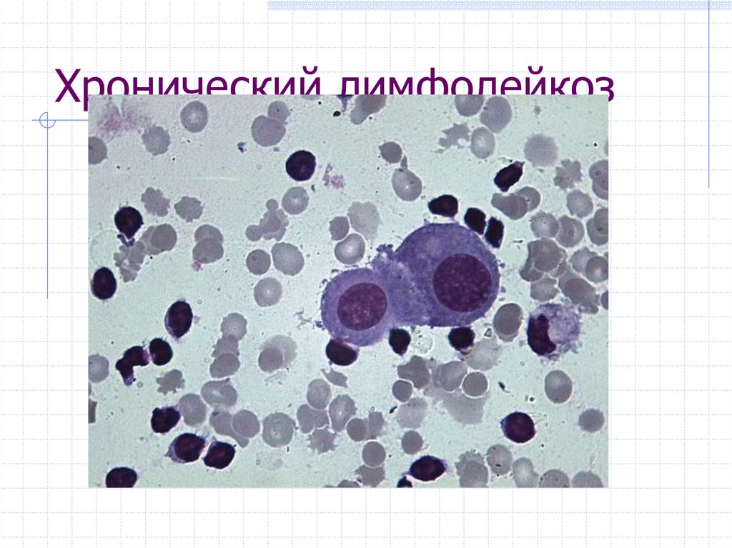 Картина воспаления. Хронический лимфолейкоз цитология. Микроскопия выпотных жидкостей. Цитология выпотных жидкостей. Специфические клетки для выпотных жидкостей.