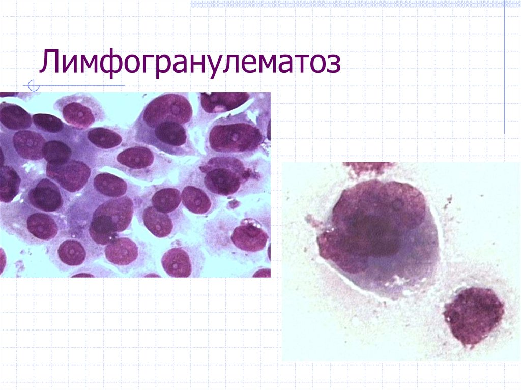 Цитологическая картина лимфомы