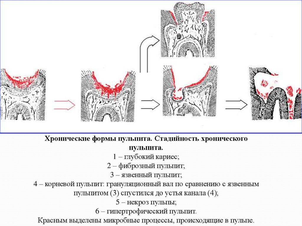 Хронические формы пульпита презентация