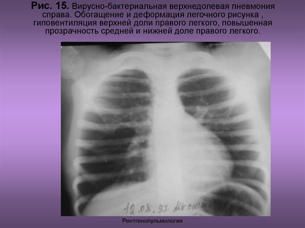 Пневмония верхней доли легкого. Левосторонняя верхнедолевая пневмония s 4. Левосторонняя нижнедолевая пневмония. Двухсторонняя верхнедолевая пневмония. Пневмония верхней доли справа.