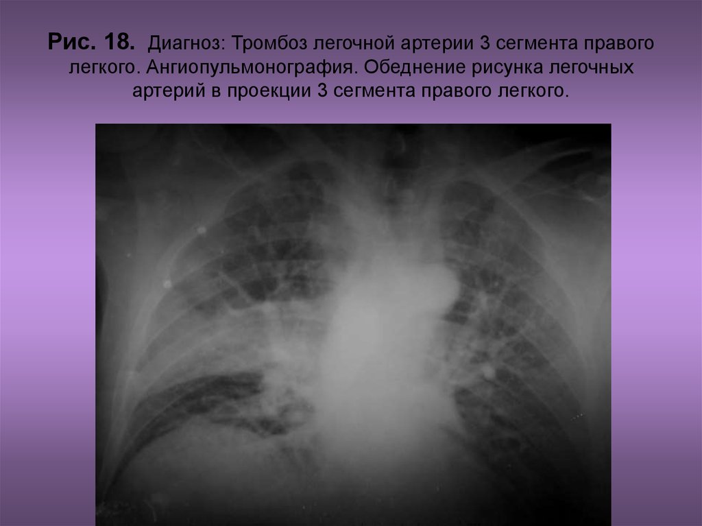 Тромбофлебит легочной артерии. Инфаркт легкого при Тэла рентген. Тромбоэмболия мелких ветвей легочной артерии рентген. Массивная Тэла рентген.