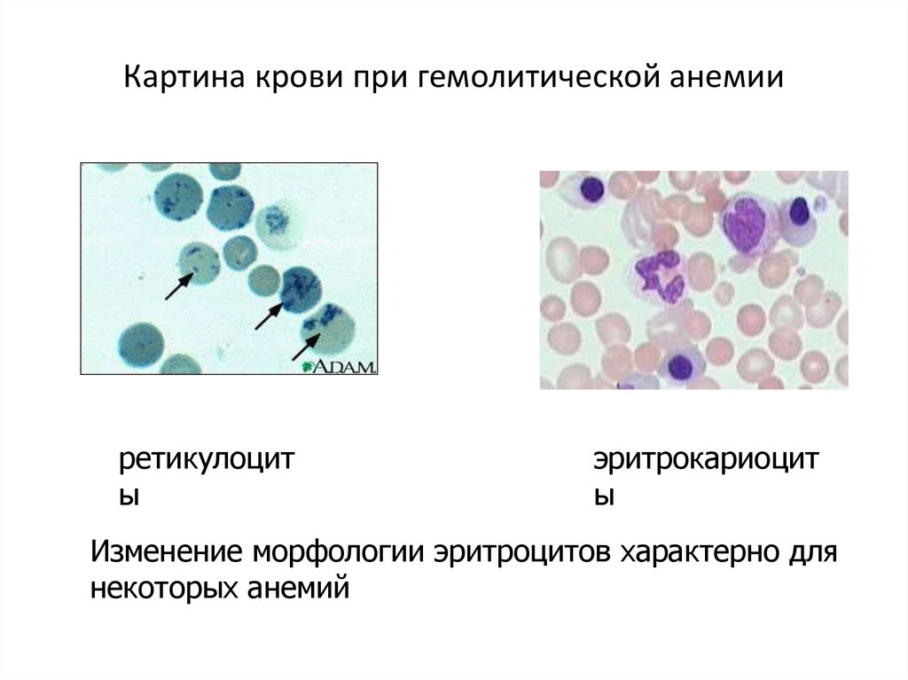 Как изменяется картина крови при анемии