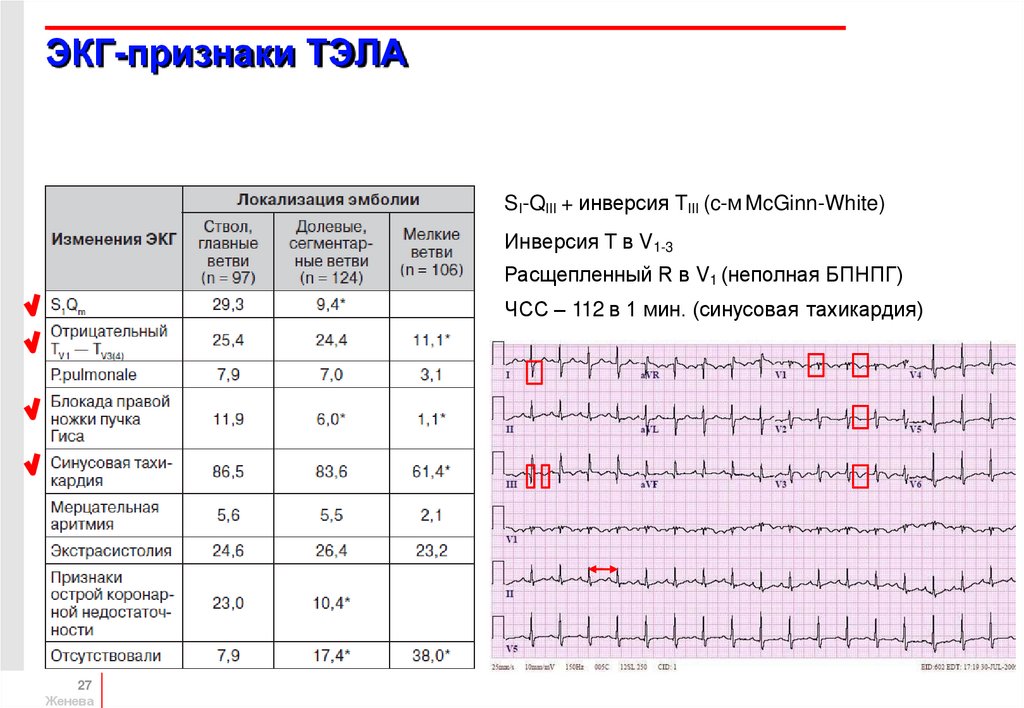 Тэла на экг картинки