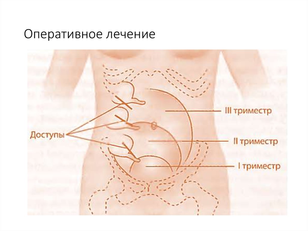 Презентация аппендицит и беременность