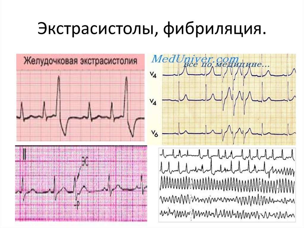 Экстрасистолы таблетки