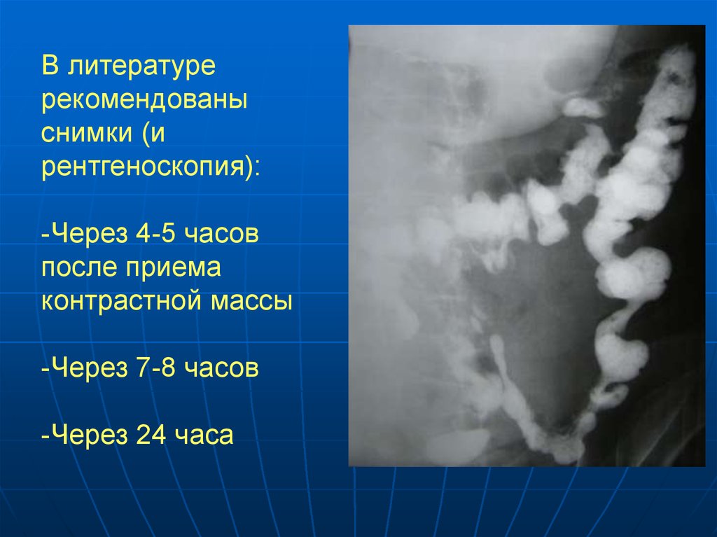 Ирригоскопия это рентгенологическое контрастное исследование. Рентгеноскопическое исследование желудка. 7.Контрастное рентгенологическое исследование желудка. Первичное двойное контрастирование желудка.