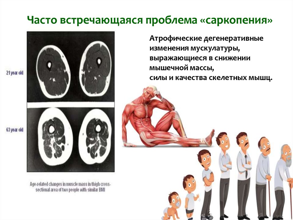 Саркопения что это такое симптомы лечение у женщин препараты схема лечения