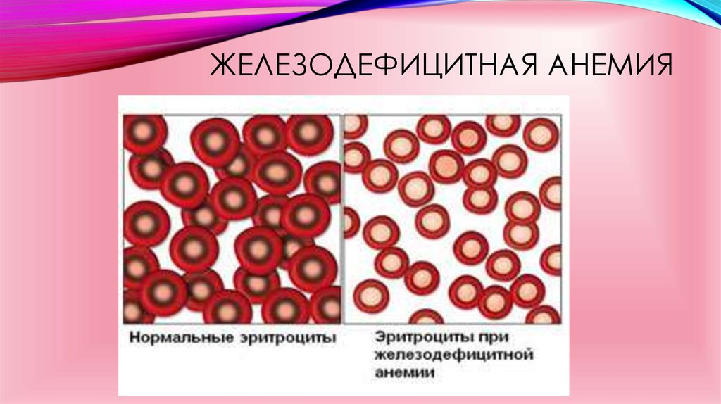 Железо дефицитная анемия. Каков диаметр эритроцитов при жда: (1). Анемия эритроциты. Эритроциты при железодефицитной. Железодефицитная анемия Эрит.