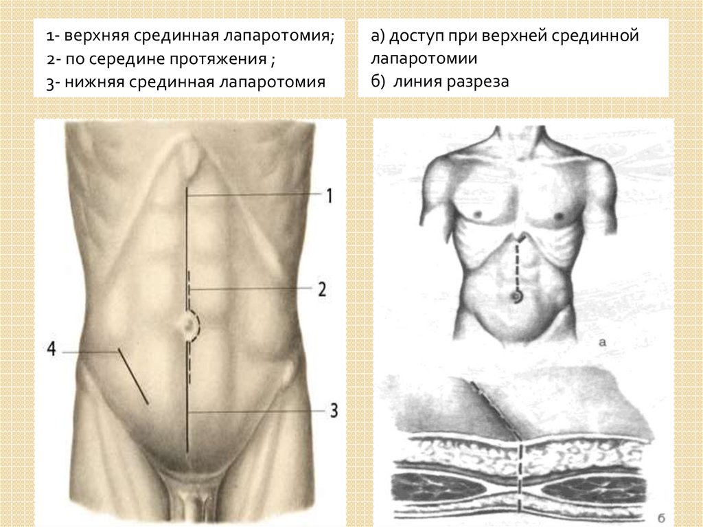 Нижняя лапаротомия. Верхняя и нижняя срединная лапаротомия. 1. Верхне-срединная лапаротомия. Срединная лапаротомия; параректальная лапаротомия.. Нижнесрединная лапаротомия при аппендэктомии.