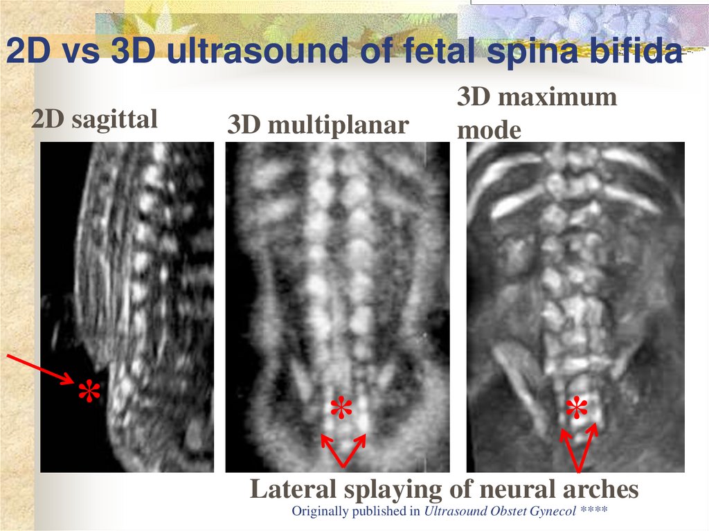 Spina bifida