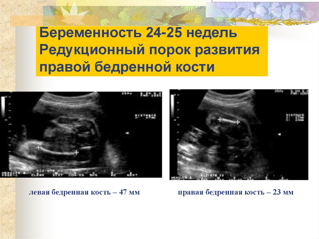 Беременность 24-25 недель Редукционный порок развития правой бедренной кости
