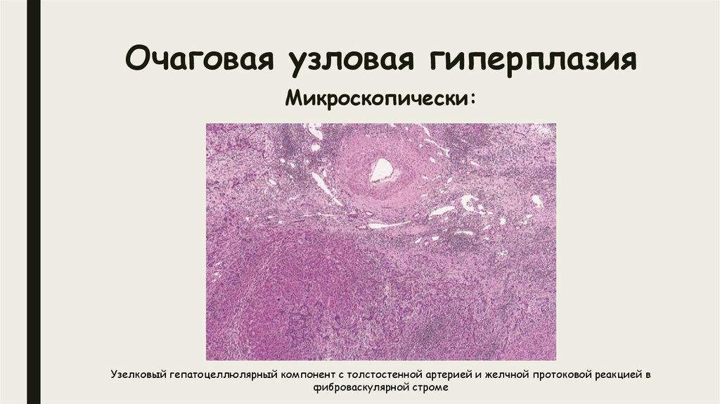Диагноз желез гиперплазия. Нодулярная гиперплазия печени гистология. Очаговая Узловая гиперплазия печени кт. Очаговая гиперплазия эндометрия. Физиологическая гиперплазия.