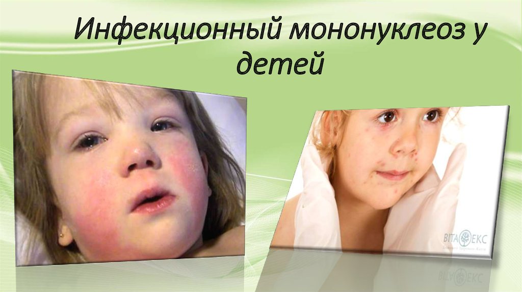 Сыпь при мононуклеозе у детей фото форум