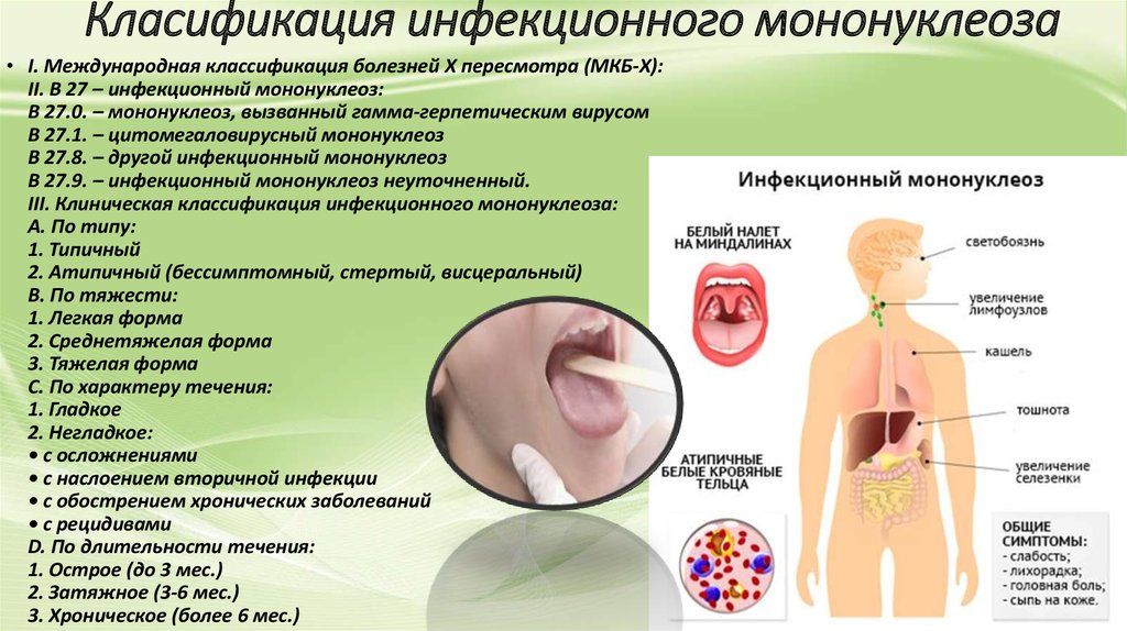 Класификация инфекционного мононуклеоза