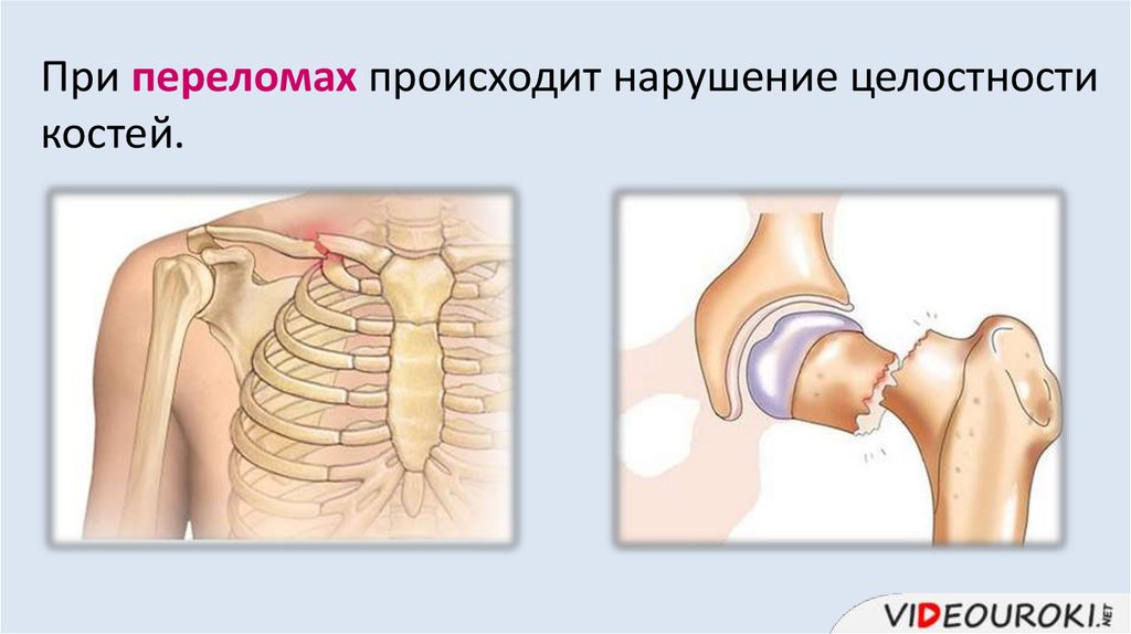 Что такое вывих. Перелом вывих растяжение. Перелом — это нарушение целостности кости.