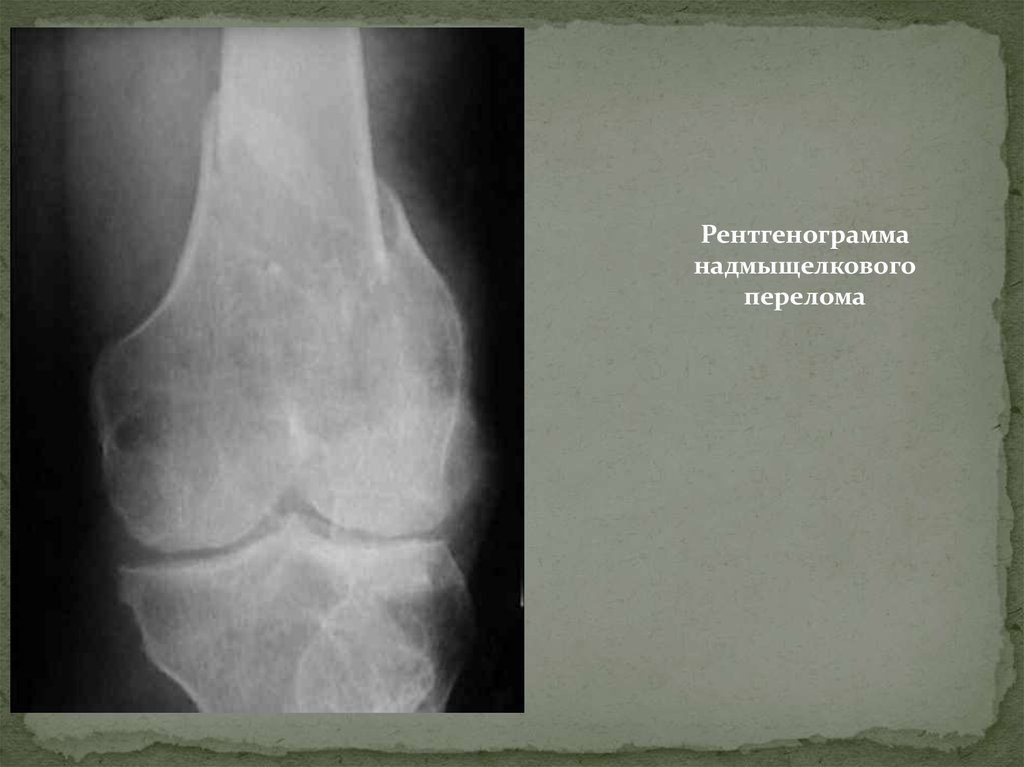 Диагностика переломов. Надмыщелковые переломы. Сгибательный надмыщелковый перелом. Надмыщелковые переломы рентгенодиагностика. Надмыщелковый перелом плеча.