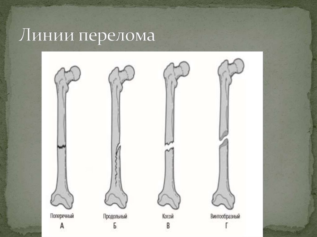 Переломы трубчатых костей. Классификация переломов по линии излома. Переломы по направлению линии излома. Диагностика переломов трубчатых костей. Рентген диагностика переломов трубчатых костей.