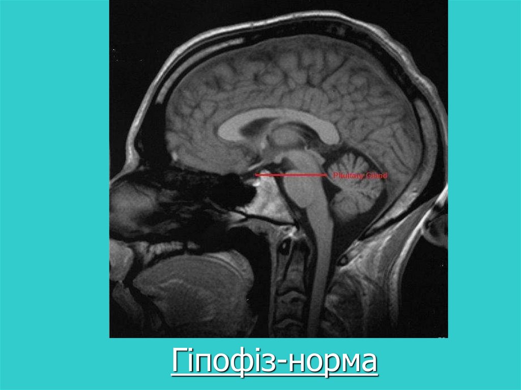 Мр картина диффузно неоднородной структуры гипофиза