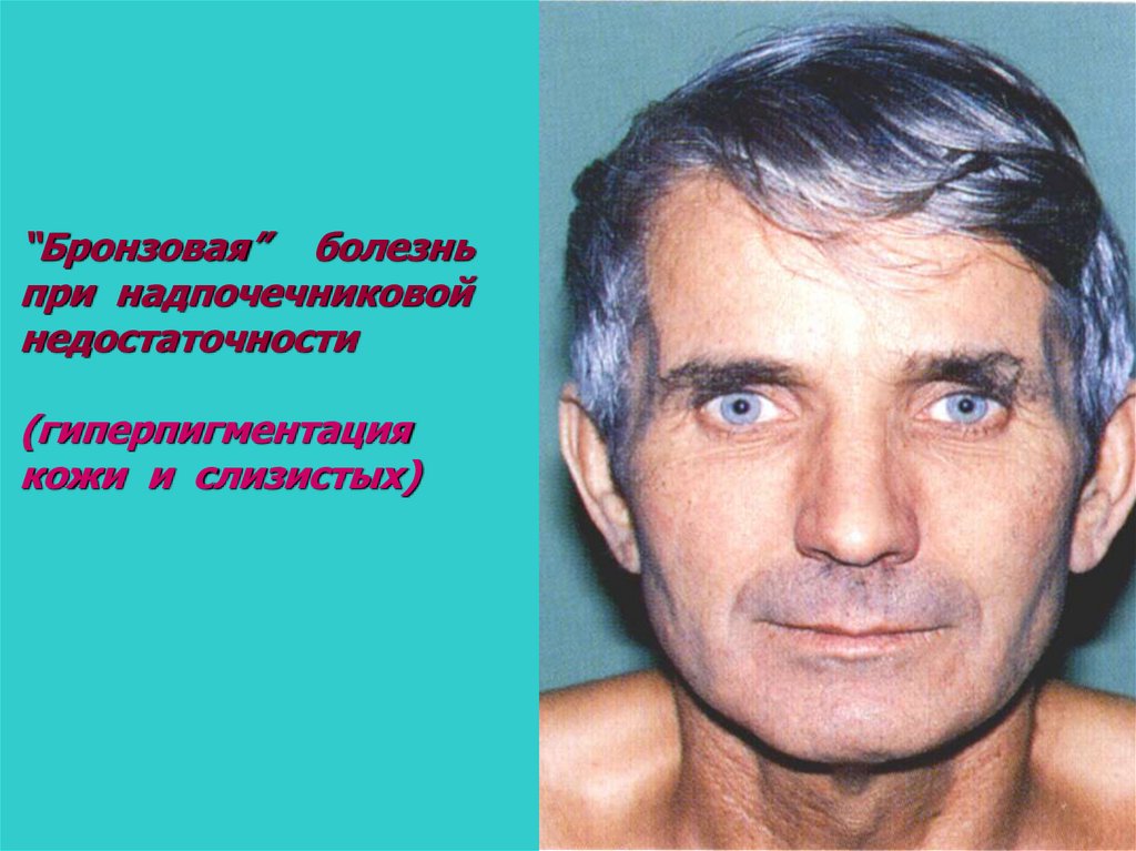 Окраска кожи. Аддисонова (бронзовая) болезнь. Болезнь Аддисона бронзовая болезнь. Бронзовая кожа болезнь Аддисона. Гиперпигментация Аддисона.