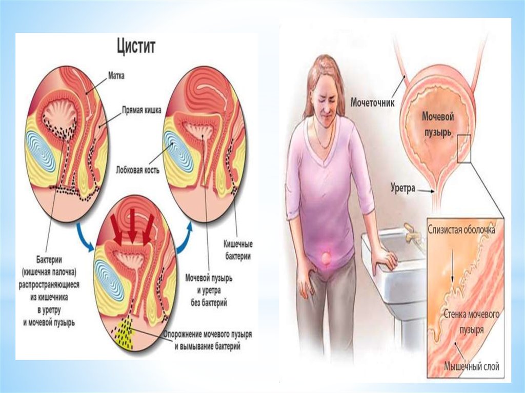 Презентация на тему цистит