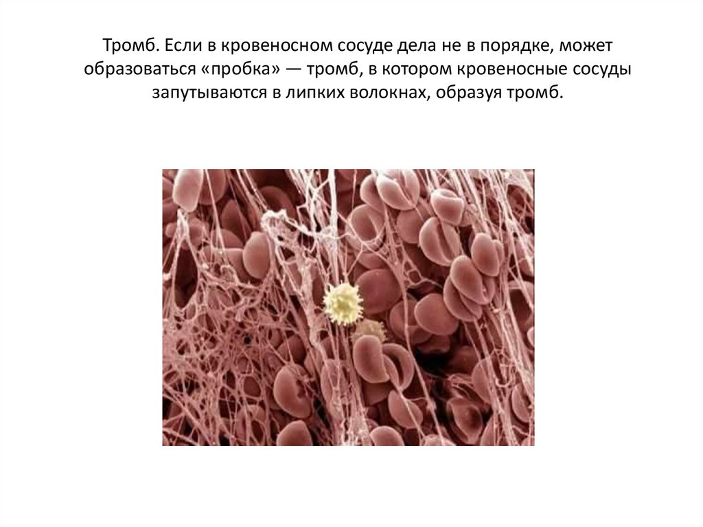 Способна образовывать тромбы. Основу тромба составляет. Что является основой тромба. Тромб в кровеносном сосуде.