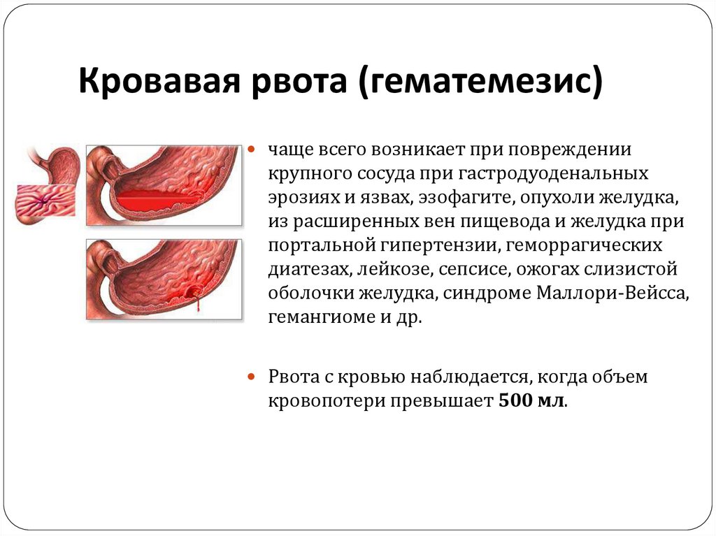 Гематемезис это