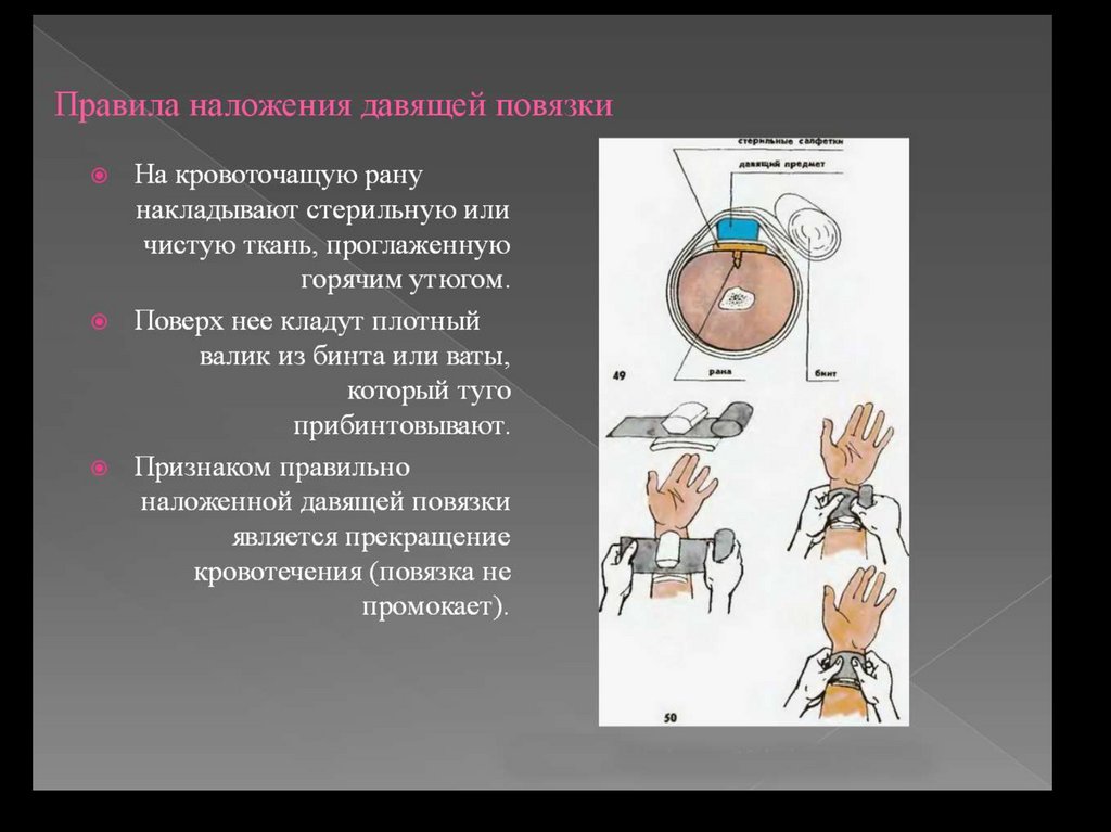 Время наложение давящей повязки. Наложение давящей повязк. Наложение тугой давящей повязки. Правило наложение давящей повязки. Наложение давящей повязки этапы.