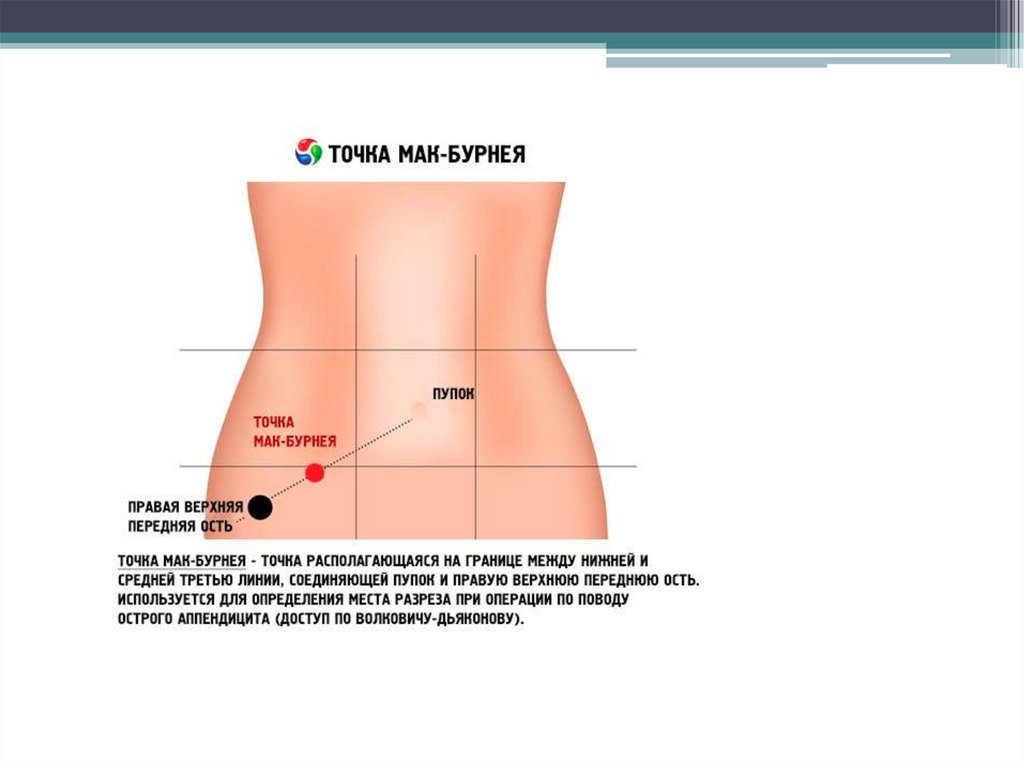 Бок кроме. Точка Ланца и Мак Бурнея. Точки боли при аппендиците. Локализация боли при аппендиците. Локализация боли при аппендиците у женщин.