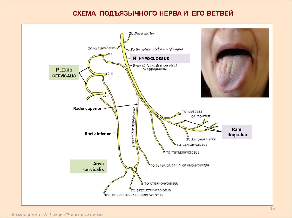Поражение языкоглоточного нерва
