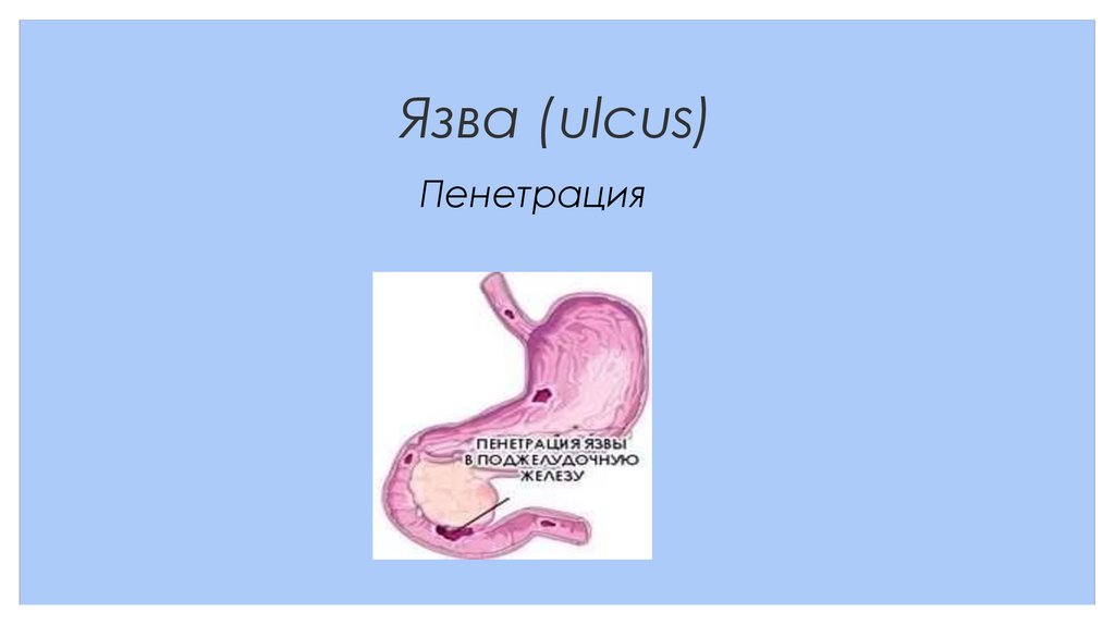 Пенетрация язвы лечение. Пенетрация язвы симптомы.