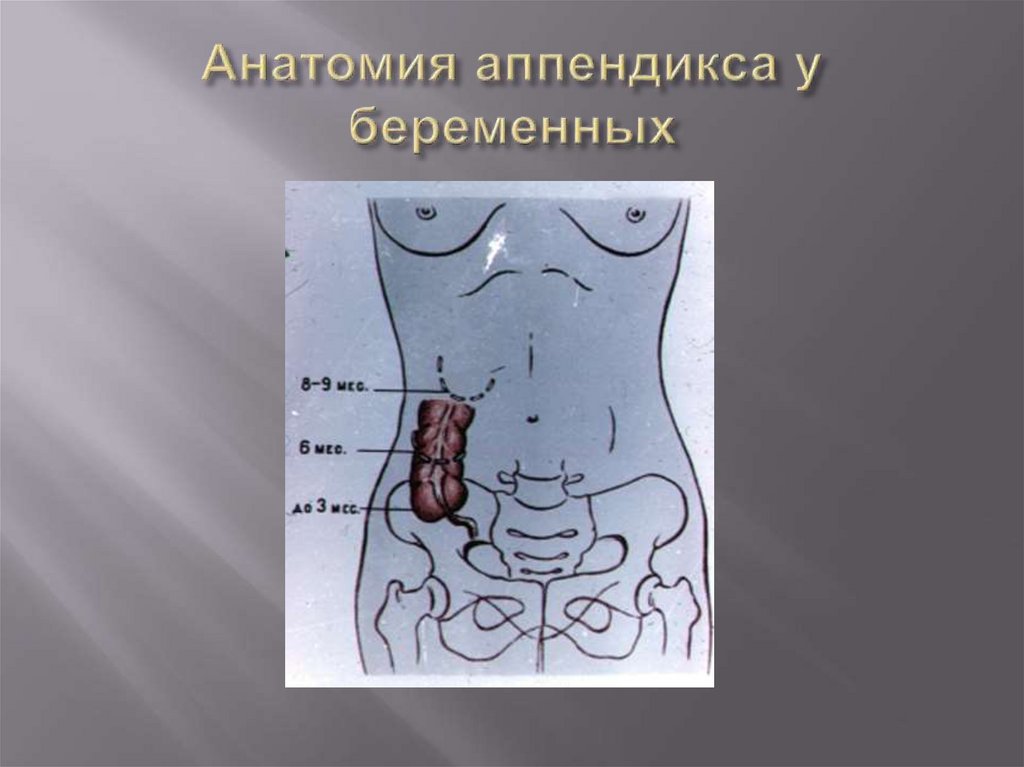 Аппендикс пример. Скелетотопия аппендикса. Анатомическое расположение аппендикса. Анатомия аппендикса расположение.