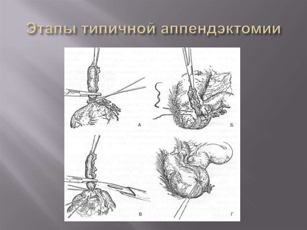 Острый аппендицит после операции