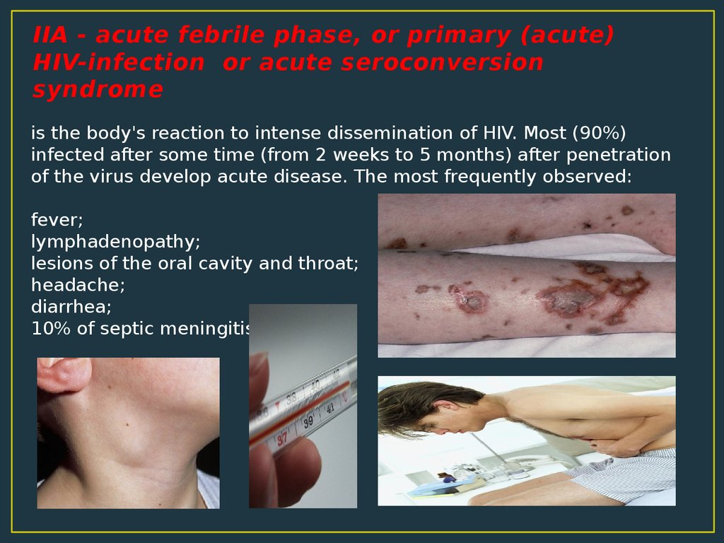 IIA - acute febrile phase, or primary (acute) HIV-infection or acute seroconversion syndrome
