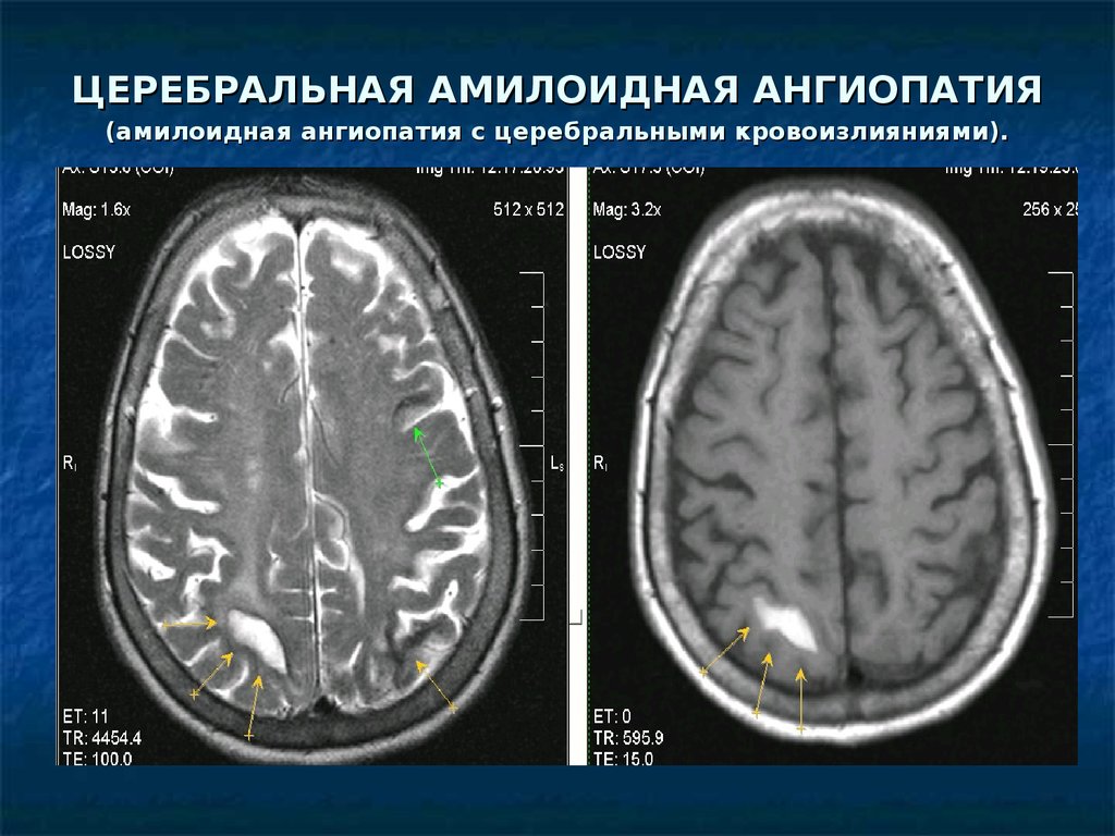 Признаки микроангиопатии головного мозга. Церебральная микроангиопатия головного мозга кт. Церебральная амилоидная ангиопатия мрт. Церебральная амилоидная энцефалопатия. Амилоидоз головного мозга мрт.