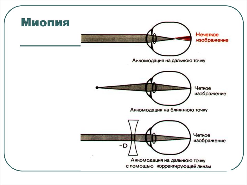 Ближняя точка. Миопия аккомодация. Точки аккомодации. Ближайшая точка аккомодации. Миопия ближайшая точка.