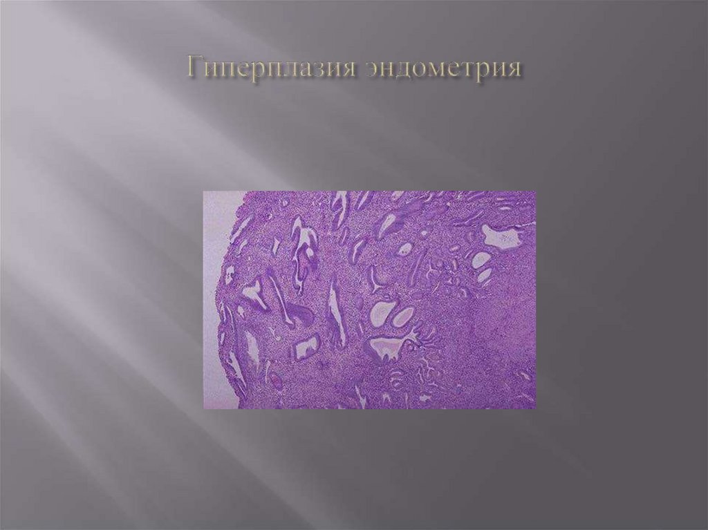 Гиперплазия эндометрия 50 лет. Гиперплазия эндометрия. Степени гиперплазии эндометрия. Гиперплазия эндометрия классификация.