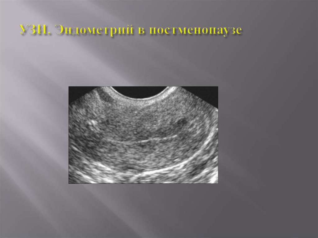 Эндометрий обратного развития. Атипическая гиперплазия эндометрия УЗИ. Структура эндометрия на УЗИ. Гиперплазия эндометрия на УЗИ.